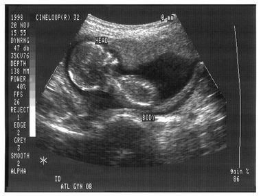 Pregnancy Ultrasound of Baby